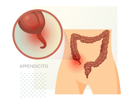 Appendicitis - Inflamed Appendix - Stock Illustration as EPS 10 Fileのイラスト素材