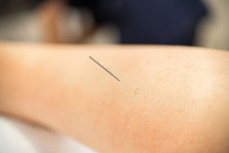 Needle of physiotherapist doing a dry needling