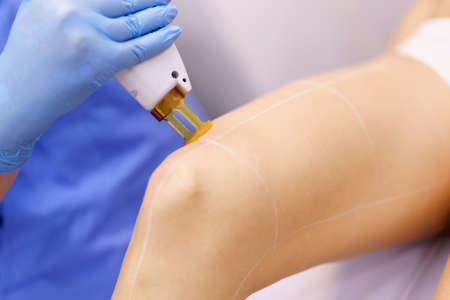 Woman receiving legs laser hair removal at a beauty center.の写真素材