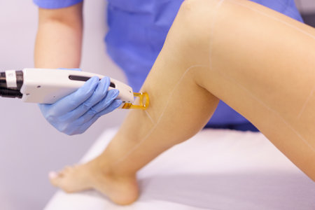 Woman receiving legs laser hair removal at a beauty center.の写真素材