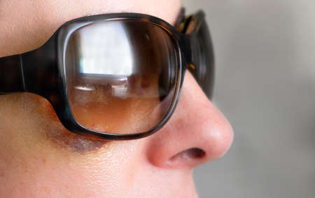 abused woman hides her black eye behind sunglasses, gender violence close upの写真素材