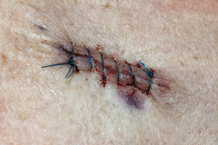 Post Operative Stitches for a Basal Cell Carcinomaの写真素材