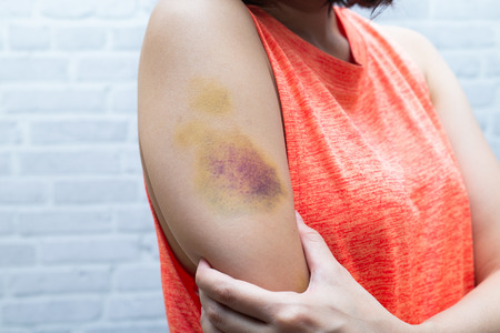 Bruise on woman arm. Injection bruises. Doctor and patient.の写真素材