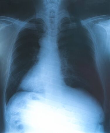 X-Rays film of lungs with virus Covid-19. Medical background pneumonia disease concept.の写真素材