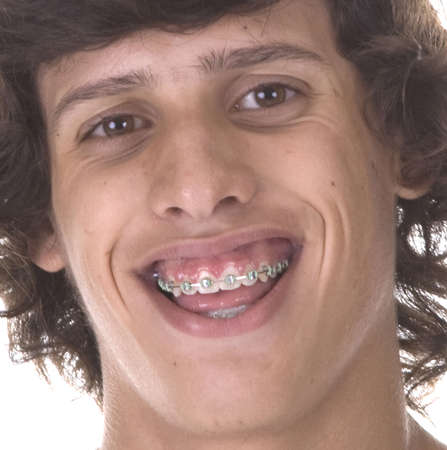 braces on his teeth in the face to smile