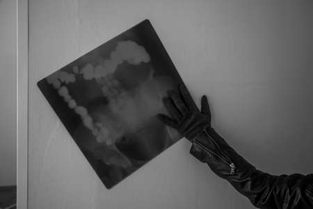 X-ray of the lungs in an abandoned hospital. A terrible disease. Human hand. Black and white photo.の写真素材