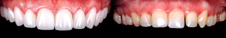 Perfect smile before and after bleaching procedure whitening of zircon arch ceramic prothesis Implants crowns. Dental restoration treatment clinic patient. Result of oral surgery dentistry,の写真素材