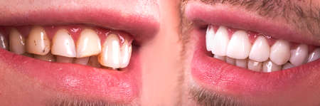 Perfect smile before and after veneers bleach of zircon arch ceramic prothesis Implants crowns. Dental restoration treatment patient. Wide Banner of oral surgery procedure whitening dentistryの写真素材