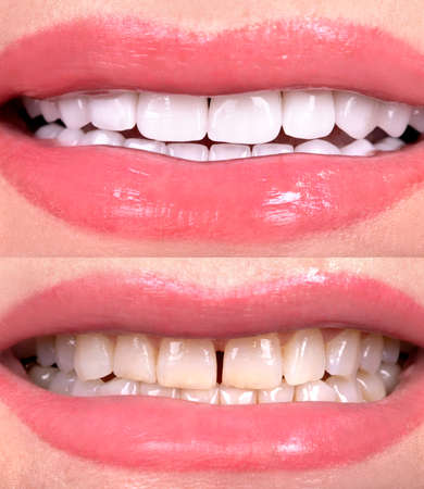 Perfect smile before and after veneers bleach of zircon arch ceramic prothesis Implants crowns. Dental restoration treatment clinic patient. Result of oral surgery procedure whitening dentistryの写真素材