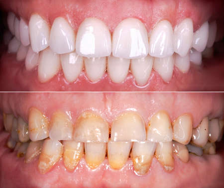 Perfect smile before and after veneers bleach of zircon arch ceramic prothesis Implants crowns. Dental restoration treatment clinic patient. Adult old woman surgery procedure whitening dentistryの写真素材