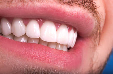 Perfect Close Up White beautiful Veneers Teeth bleaching crowns whitening young lady smiling, Male beard natural man smile. Dental zircon implants restoration surgery. Fashion conceptの写真素材