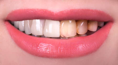 Perfect smile whitening before and after veneers bleach of zircon whitening young lady smiling. Implants crowns. Dental restoration treatment clinic patient. Oral Care concept surgery procedureの写真素材