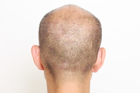 thin hair