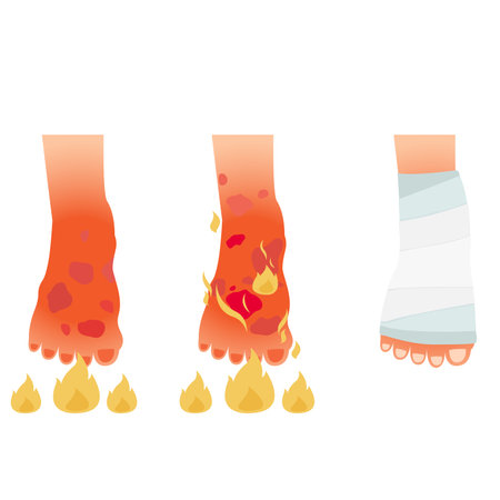 Burn of foot human skin vector illustrationのイラスト素材