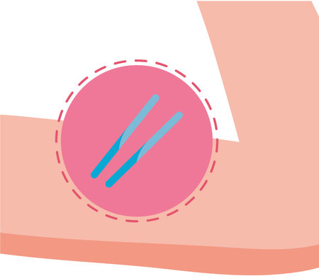 contraceptive implant designのイラスト素材