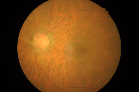Medical photo of retinal pathology, Disorders of sclera, cornea, cataract