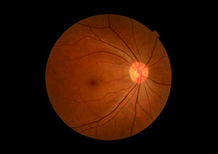 Medical photo tractional (eye screen) diabetes retinal screening