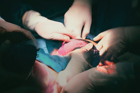 Double Exposure of The birth of a baby from the womb.New life in  opelation labor roomの写真素材