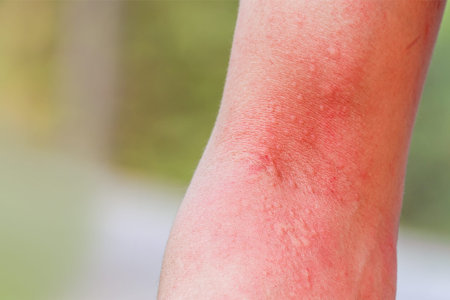 close up skin allergy itching on arm skin body allergic a caterpillar sting or insect bites...
