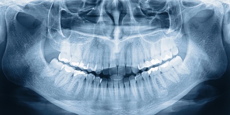 X-ray scan of humans teethの写真素材