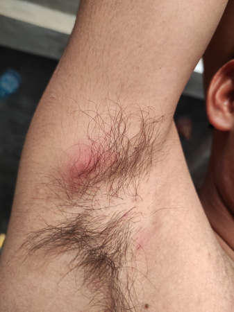 A Closeup Shot Of Armpit Acne Stock Video Footageの写真素材