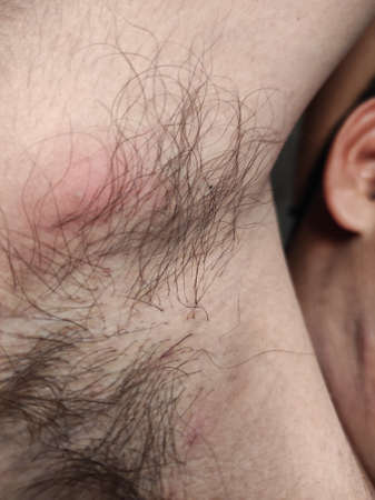 A Closeup Shot Of Armpit Acne Stock Video Footageの写真素材