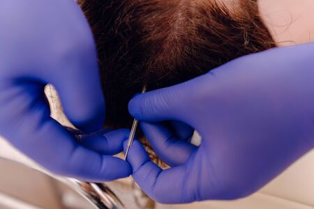 Traditional chinese medicine treatment acupunctureの写真素材