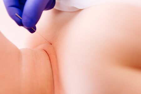 Young woman getting acupuncture treatment. Doctor sticks needles into the girl's body, closeup. Traditional Chinese treatment, alternative medicineの写真素材