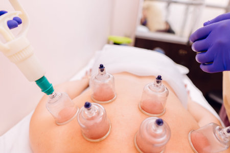 Woman receiving cupping treatment- Hijama