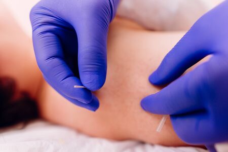 Physiotherapist doing acupuncture to a young womanの写真素材