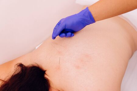 Alternative medicine. Traditional Chinese treatment. Female back with steel needles during procedure of acupuncture therapy.の写真素材