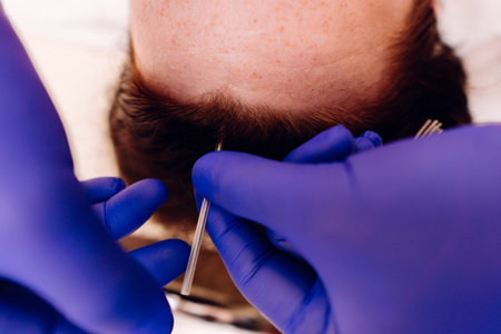 Traditional chinese medicine treatment acupuncture