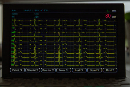 Screen of electrocardiograph device showing twelve yellow ECG cardiograph rhythm leads.の写真素材