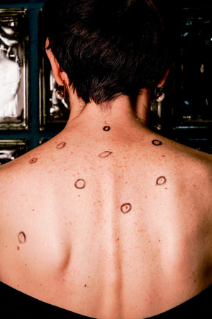 back of woman with sunburned skin, small carcinomas and or melanomas.
