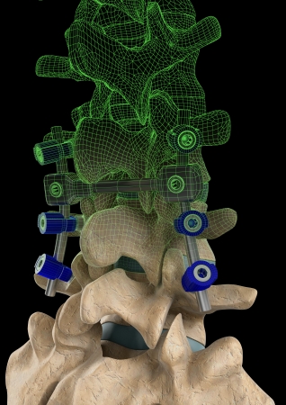 Rendering of a spine with a screw support system and a computer generated wire frame on a black background.の写真素材