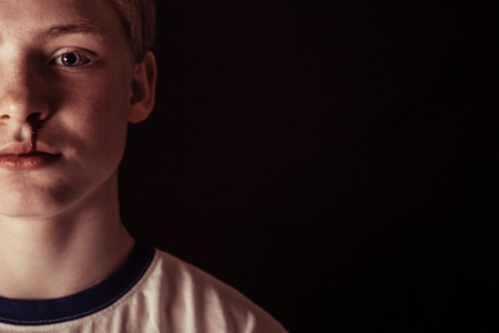 Cropped front view on blond boy with bloody nose over dark background with copy spaceの写真素材
