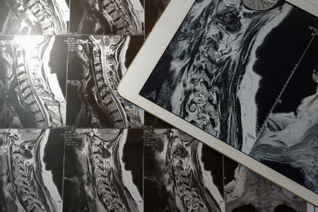 MRI Pictures of spinal column with magnification on overlaying tabletの写真素材