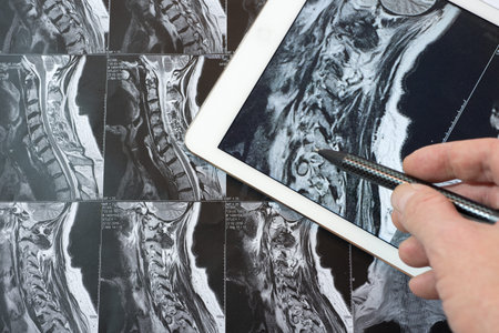 MRI Pictures of spinal column , Doctor pointing to the problemの写真素材
