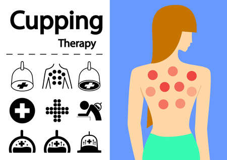 Hijama or Cupping Therapy Icons in flat vector art designのイラスト素材