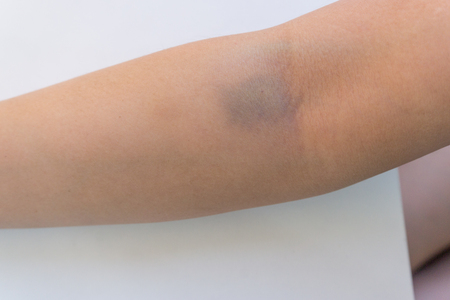 bruises on armの写真素材