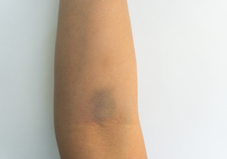bruises on armの写真素材