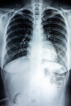 Film X-ray of breast a person, Film grain styleの写真素材