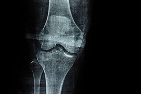 Film X-ray of a leg bone person, Film grain styleの写真素材