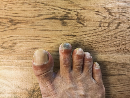 Subungual hematoma blue black toenail. Subungual hematoma under long toe or pointer toe. Subungual...