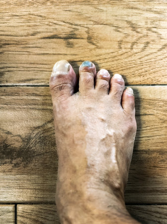 Subungual hematoma blue black toenail. Subungual hematoma under long toe or pointer toe. Subungual...