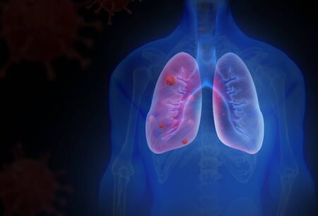 Human lungs infected by virus and bacteria. 3d illustration. Lungs Anatomy.の写真素材