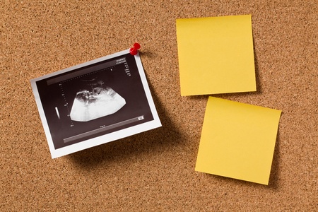 the ultrasound photo on corkboardの写真素材