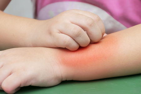 Allergies from mosquito bites. Children are scratching their arms. After the mosquito bites. Scratch until redness.の写真素材