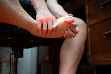 Man with painful and inflamed gout on his foot around the big toe area. Gout disease in Human, Auto immune disorder in humans. joint pain.の写真素材