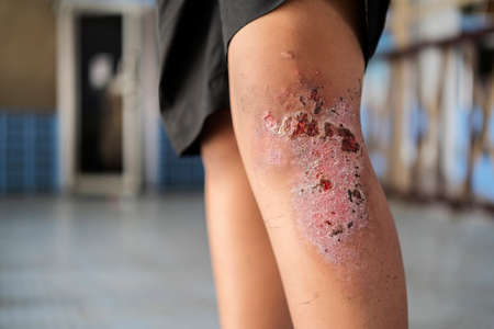 Dry scab on the wounded knee of an boy with blurred background.の写真素材